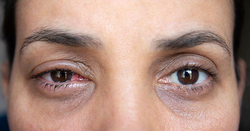 Telling the Difference Between Pink Eye & Styes
